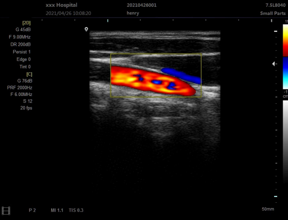 MUC-180 Laptop Color Doppler Ultrasound Scanner