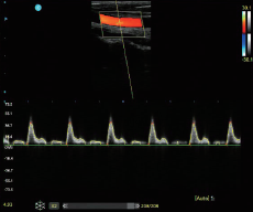 Portable Color Doppler Ultrasound Scanner