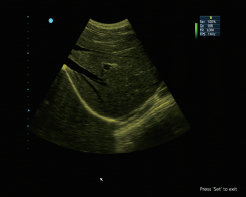 Portable Color Doppler Ultrasound Scanner