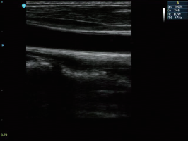 Portable Color Doppler Ultrasound Scanner