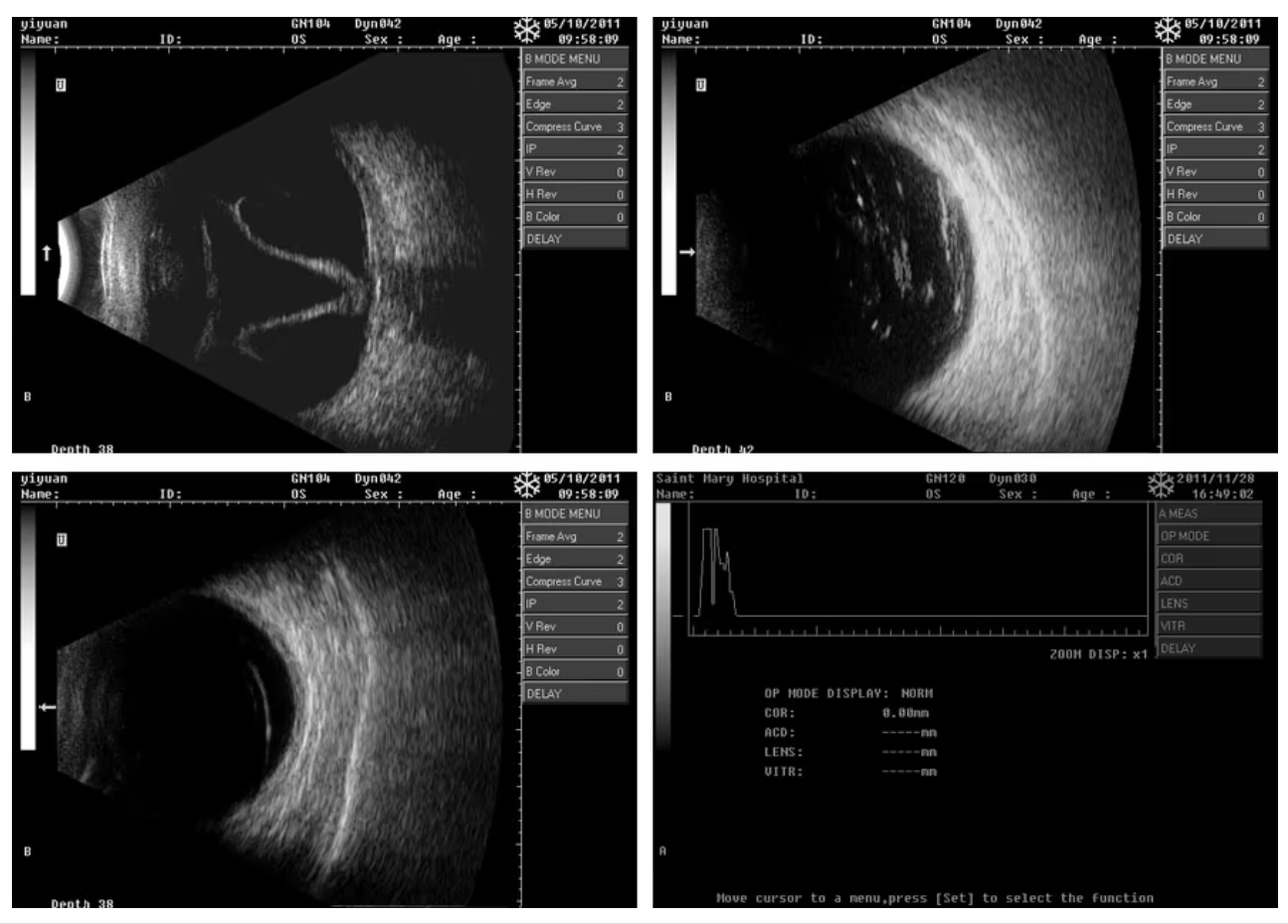 MO-300 Medical Portable Full Digital A / B Ophthalmic Ultrasound Scanner